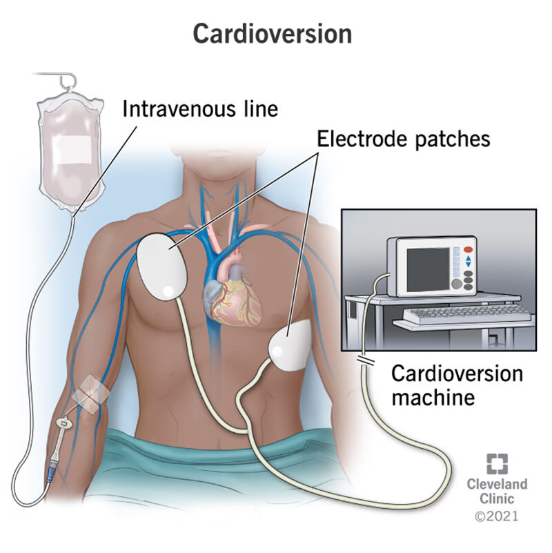 synchronized cardioversion